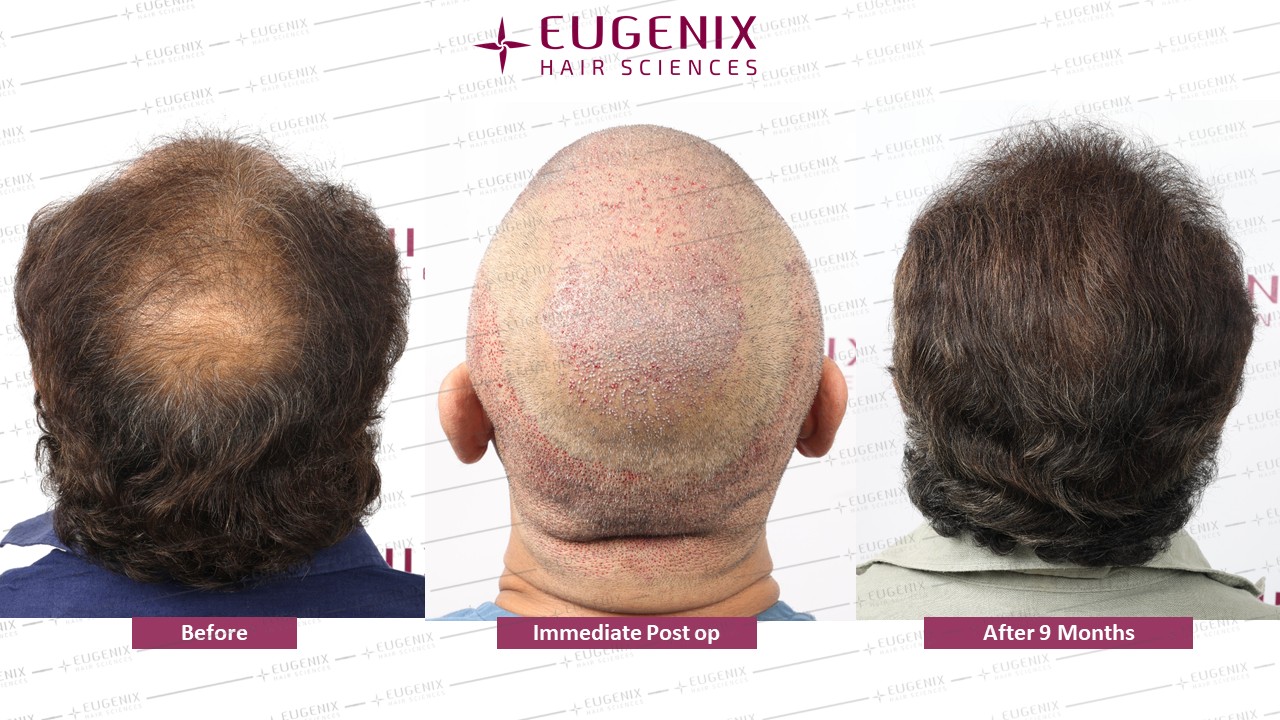 https://cdn.forumhairtransplant.com/original/3X/6/e/6eb16d8ecae82ca027d7bc68b8dc0ae50d8c40d2.jpeg