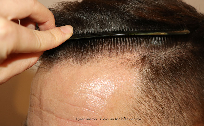 Case performed by Dr. Feriduni – 4008 FU in 1 procedure photo