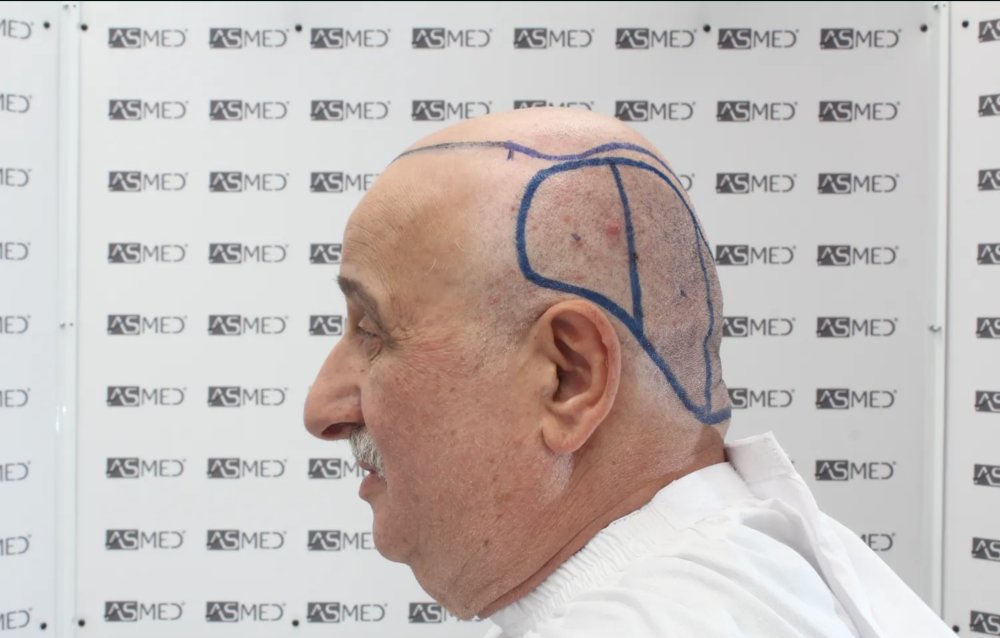 Asmed Clinic - FUE - 4558 Grafts - 12 Month Result. photo