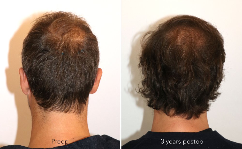 Case performed by Dr. Feriduni – 3378 FU in 1 procedure photo