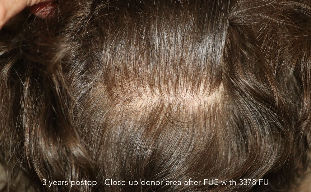 Case performed by Dr. Feriduni – 3378 FU in 1 procedure photo