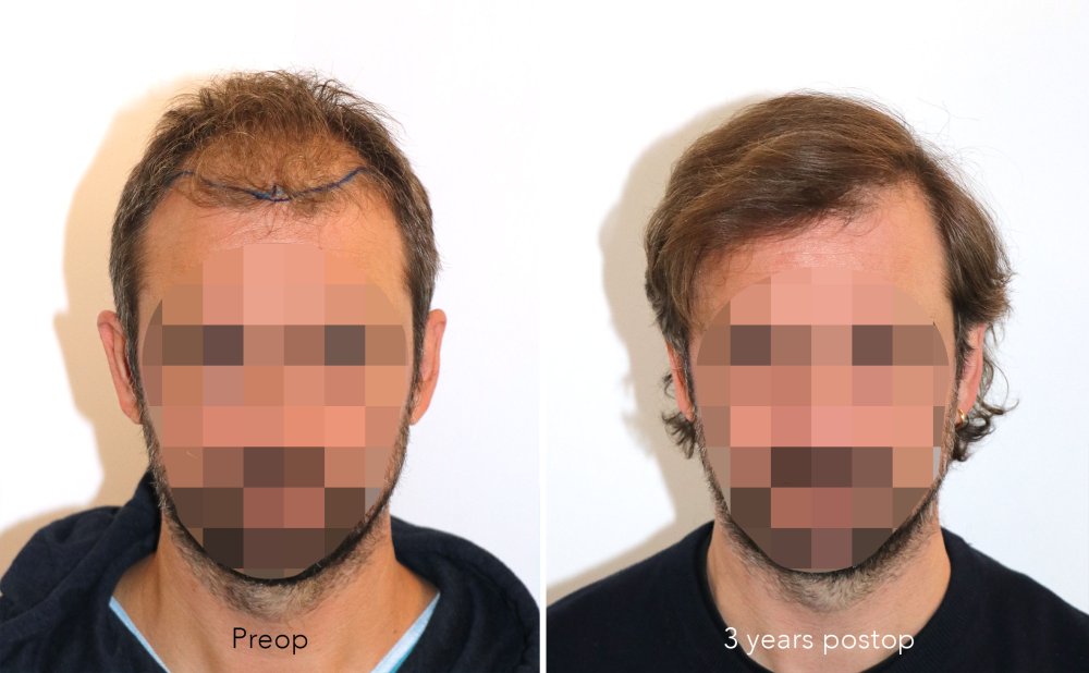 Case performed by Dr. Feriduni – 3378 FU in 1 procedure photo