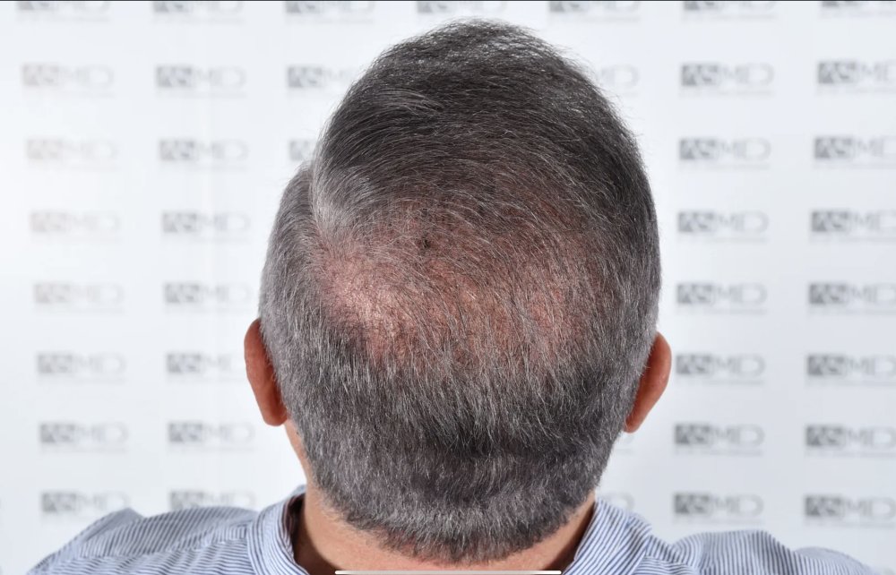 Asmed Clinic - FUE - 4558 Grafts - 12 Month Result. photo