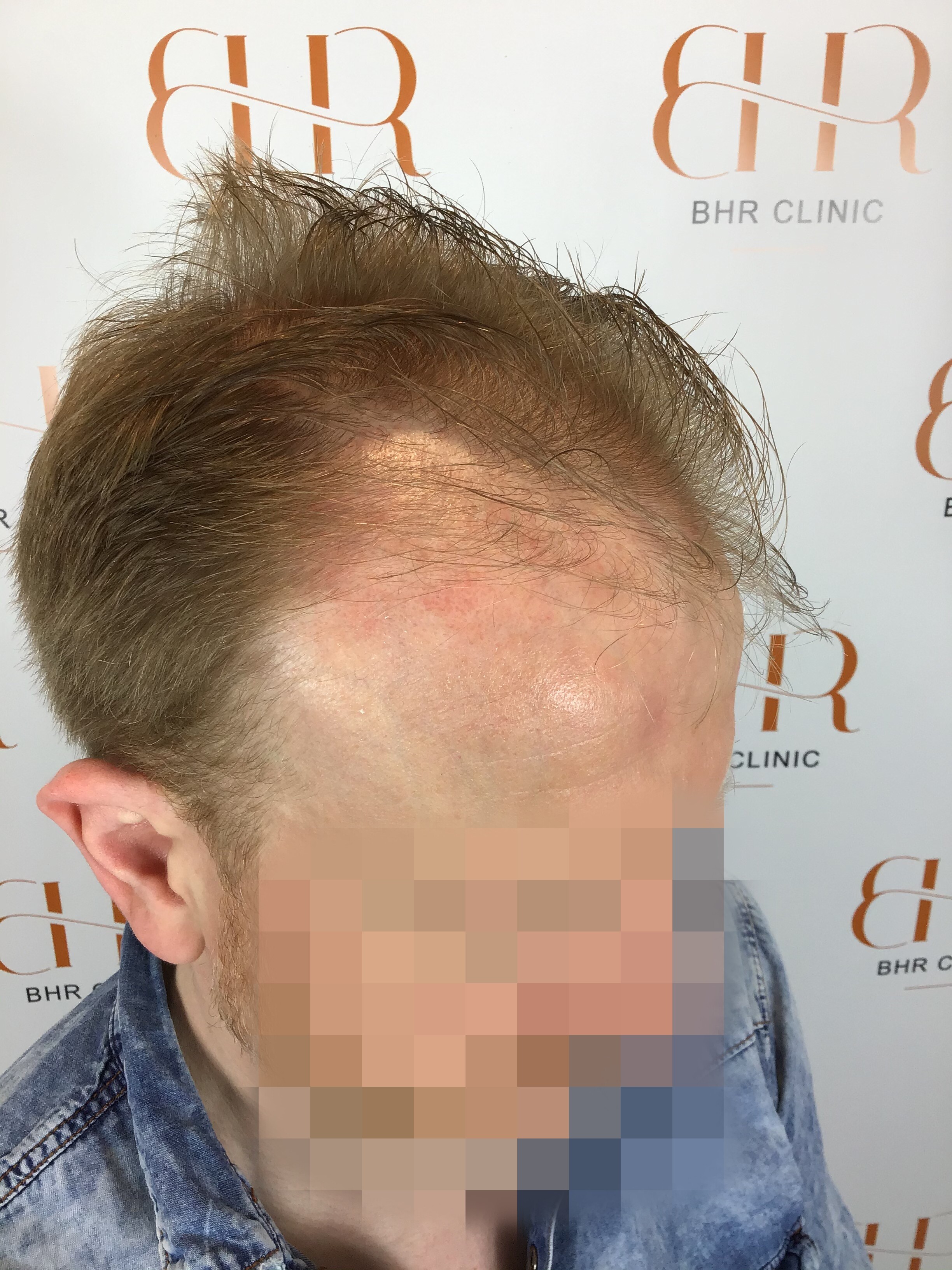 Dr. Bisanga BHR Clinic - 3001 FUE 0 - 15 Months - Fine Blond Hair photo