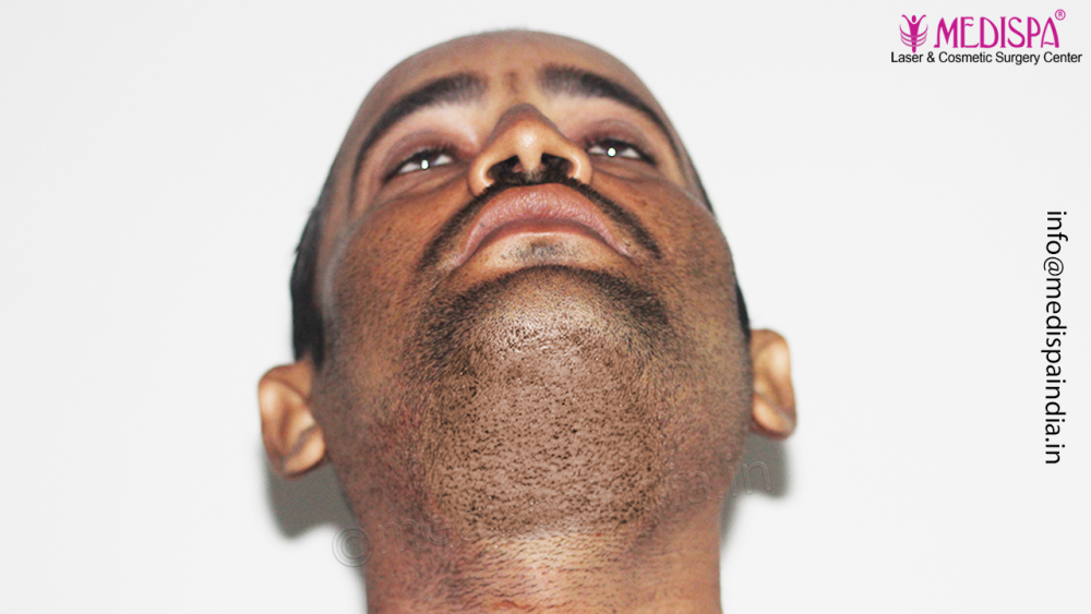Dr. Suneet Soni - 4992 Grafts | 12-Month Result | Combination FUT + FUE + Beard photo
