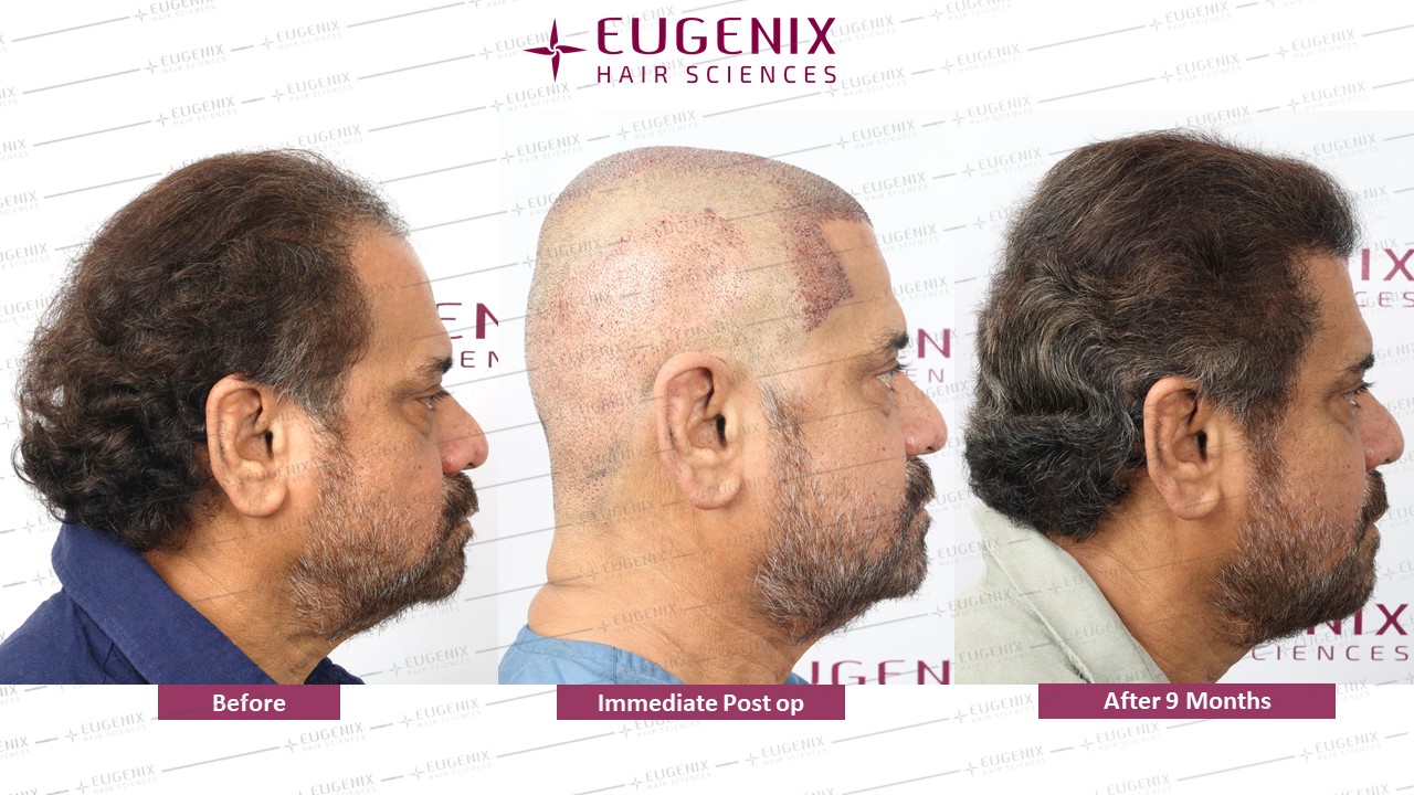 https://cdn.forumhairtransplant.com/original/3X/8/5/85f79b2923b13267cee8b05996b86b8d41786cce.jpeg