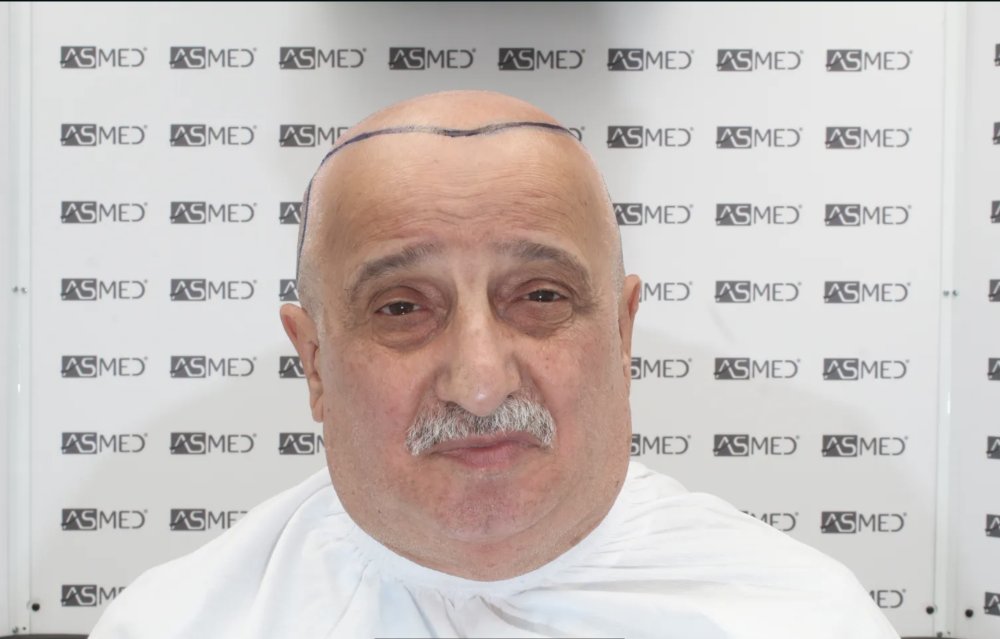 Asmed Clinic - FUE - 4558 Grafts - 12 Month Result. photo