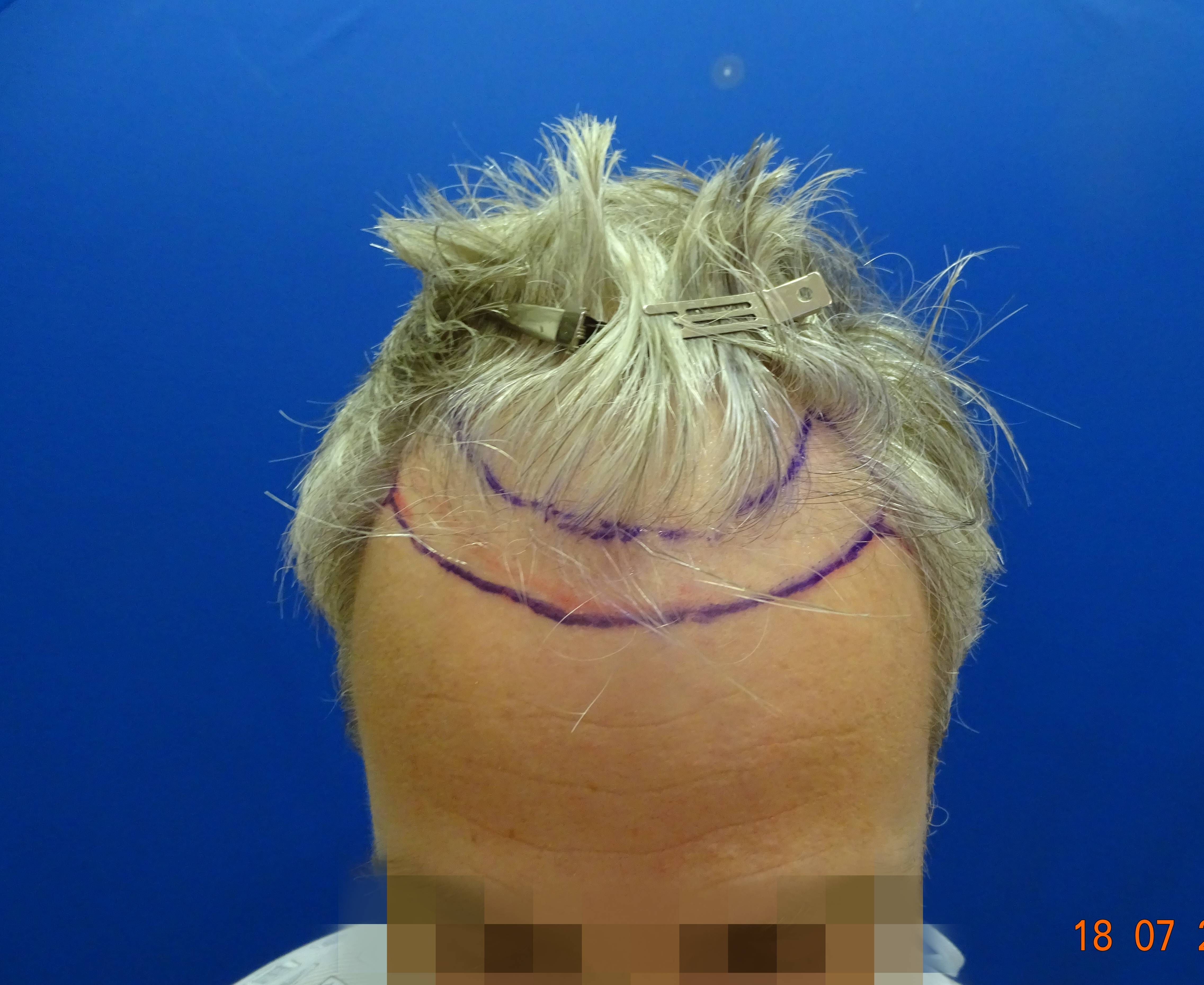 Dr. Bisanga - BHR Clinic - 2180 FUE Repair 0 - 17 Months - Graft Removal and Hairline Reconstruction photo