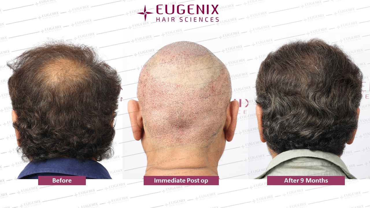 https://cdn.forumhairtransplant.com/original/3X/8/d/8dd3e1ab798cc22b914d5569e691ed796d1cfbfd.jpeg