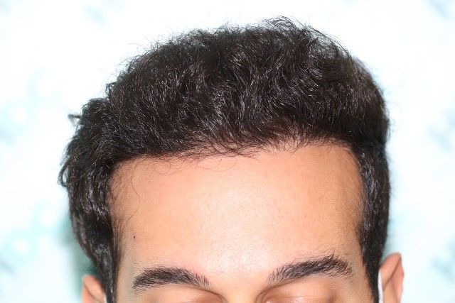 FUE Result for hairline and temples – 1 Year after 2980 grafts – HDC Hair Clinic photo