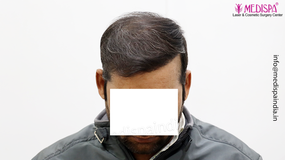 Dr. Suneet Soni - 4992 Grafts | 12-Month Result | Combination FUT + FUE + Beard photo