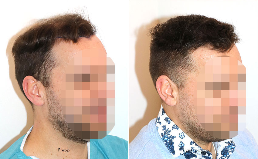 Case performed by Dr. Feriduni – 4008 FU in 1 procedure photo