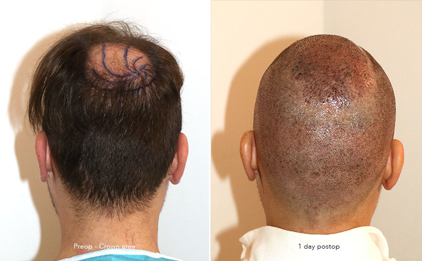 Case performed by Dr. Feriduni – 4008 FU in 1 procedure photo