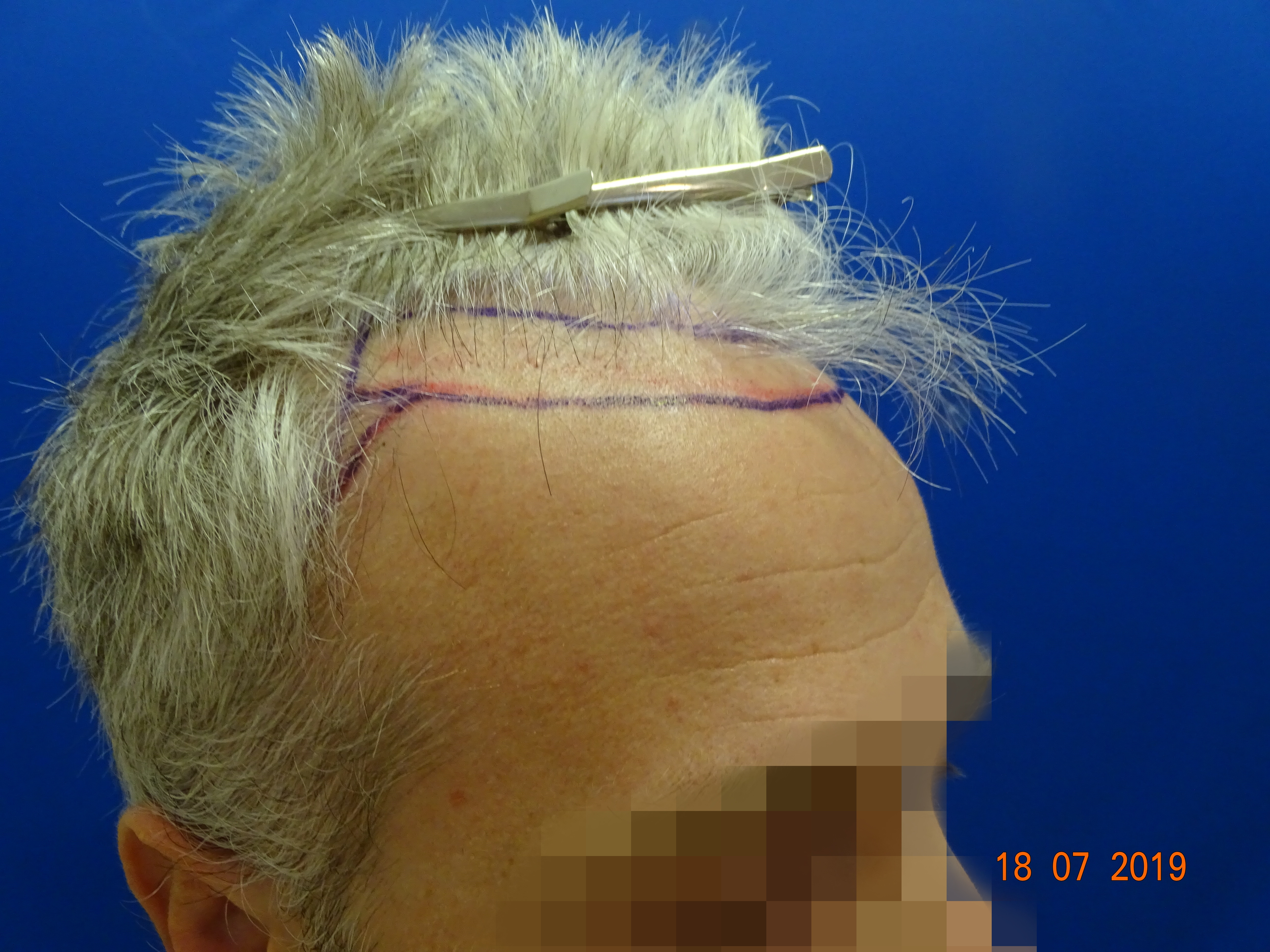 Dr. Bisanga - BHR Clinic - 2180 FUE Repair 0 - 17 Months - Graft Removal and Hairline Reconstruction photo