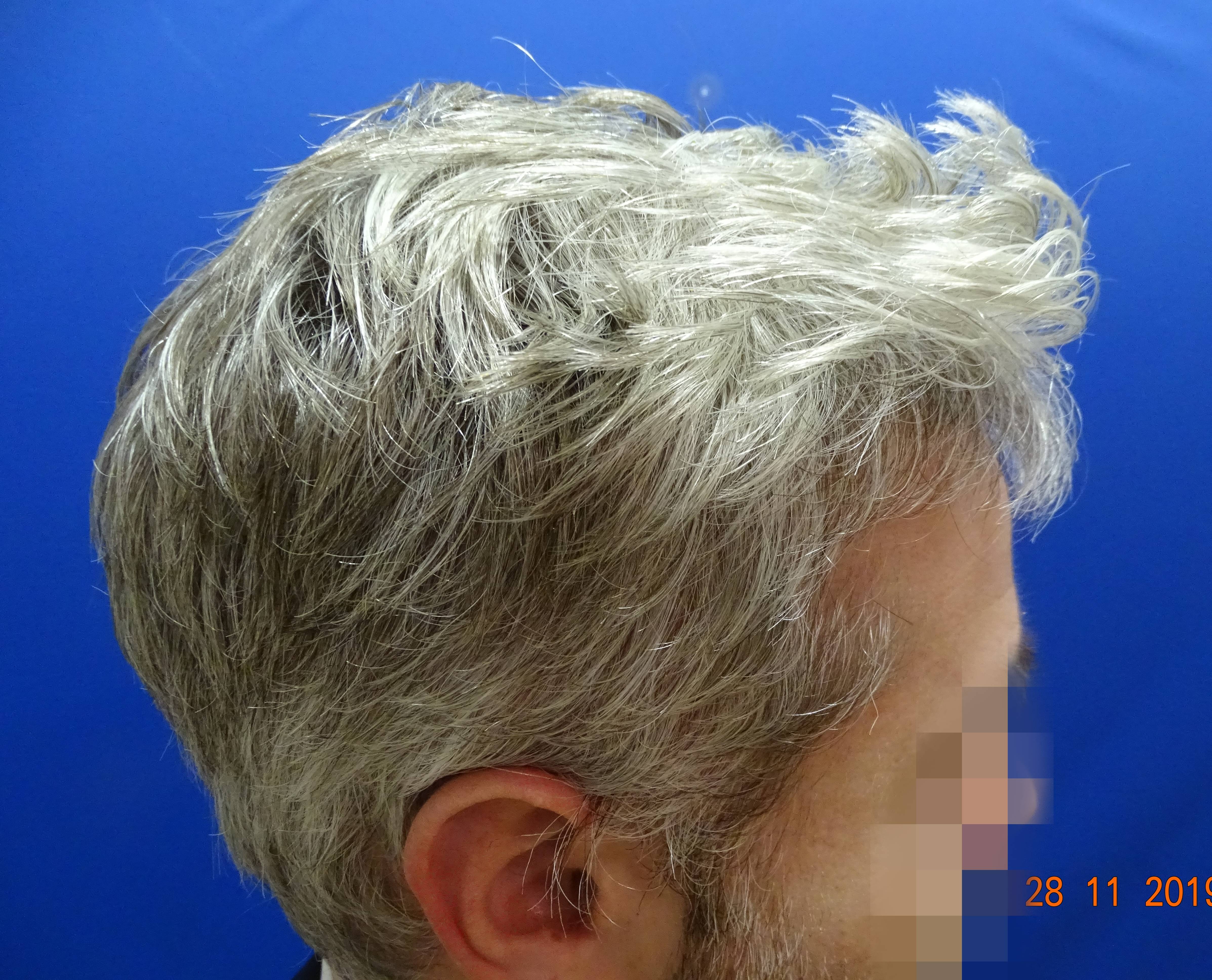 Dr. Bisanga - BHR Clinic - 2180 FUE Repair 0 - 17 Months - Graft Removal and Hairline Reconstruction photo