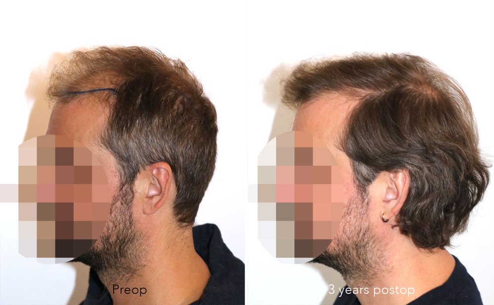Case performed by Dr. Feriduni – 3378 FU in 1 procedure photo