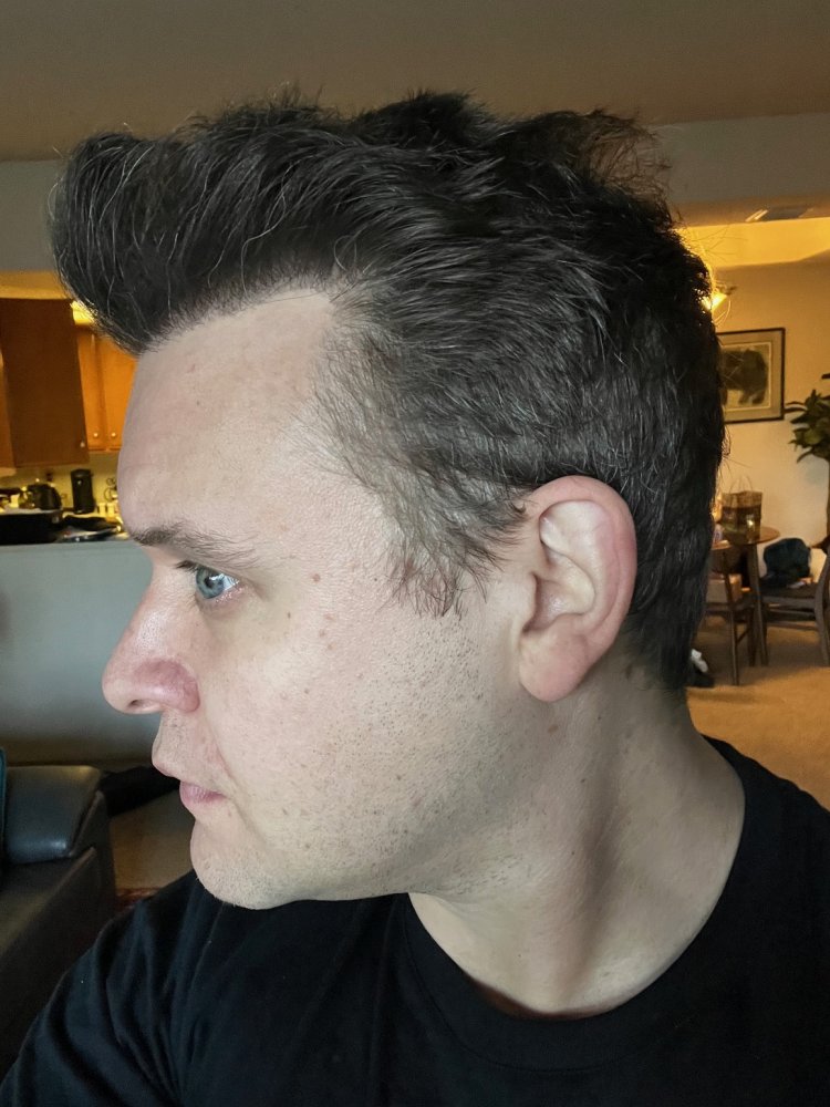 Dr. Ischayek hair restoration result - 1,443 grafts alviarmani photo