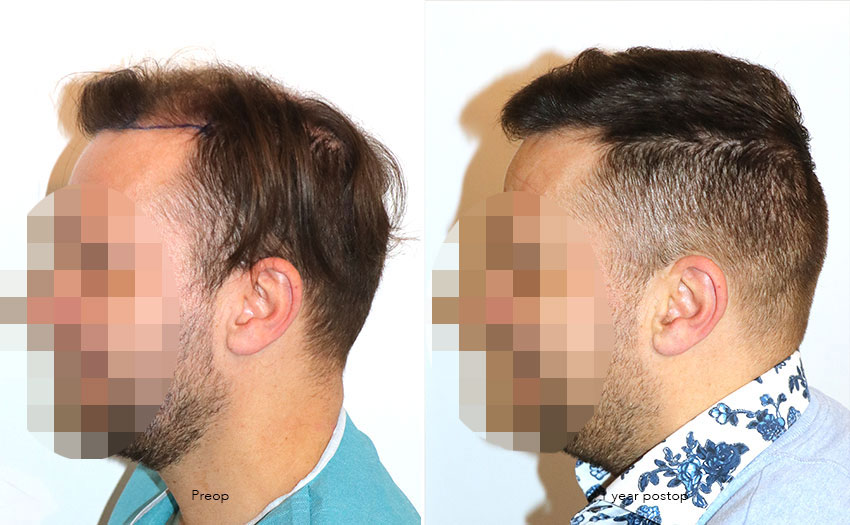 Case performed by Dr. Feriduni – 4008 FU in 1 procedure photo