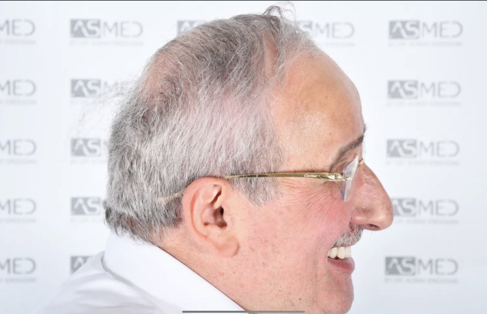 Asmed Clinic - FUE - 4558 Grafts - 12 Month Result. photo