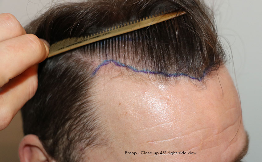 Case performed by Dr. Feriduni – 4008 FU in 1 procedure photo