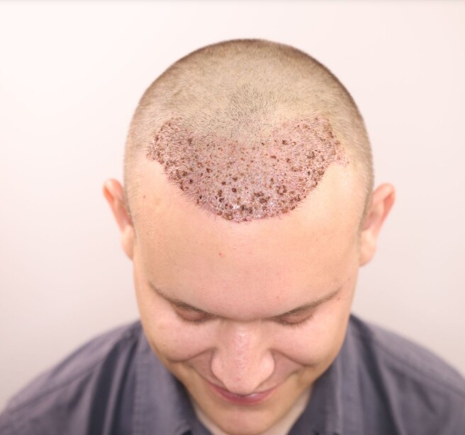 Dr. Ischayek hair restoration result - 1,443 grafts alviarmani photo