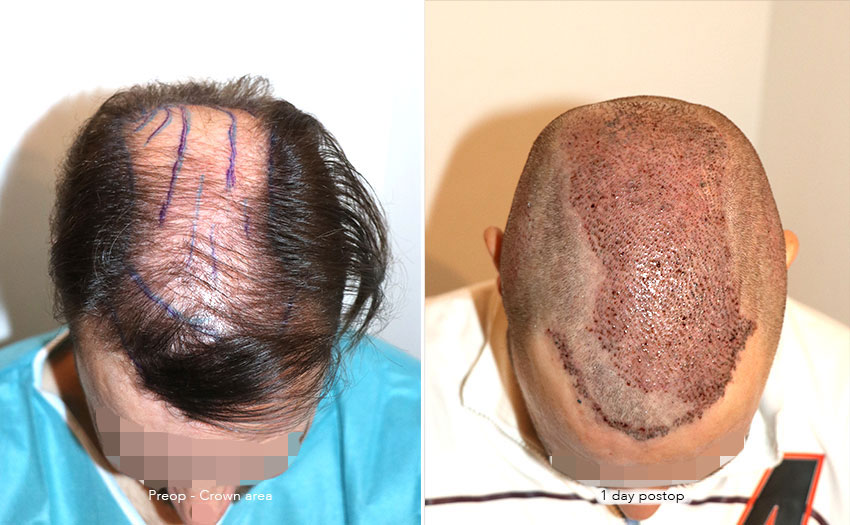 Case performed by Dr. Feriduni – 4008 FU in 1 procedure photo