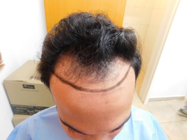 FUE Result for hairline and temples – 1 Year after 2980 grafts – HDC Hair Clinic photo