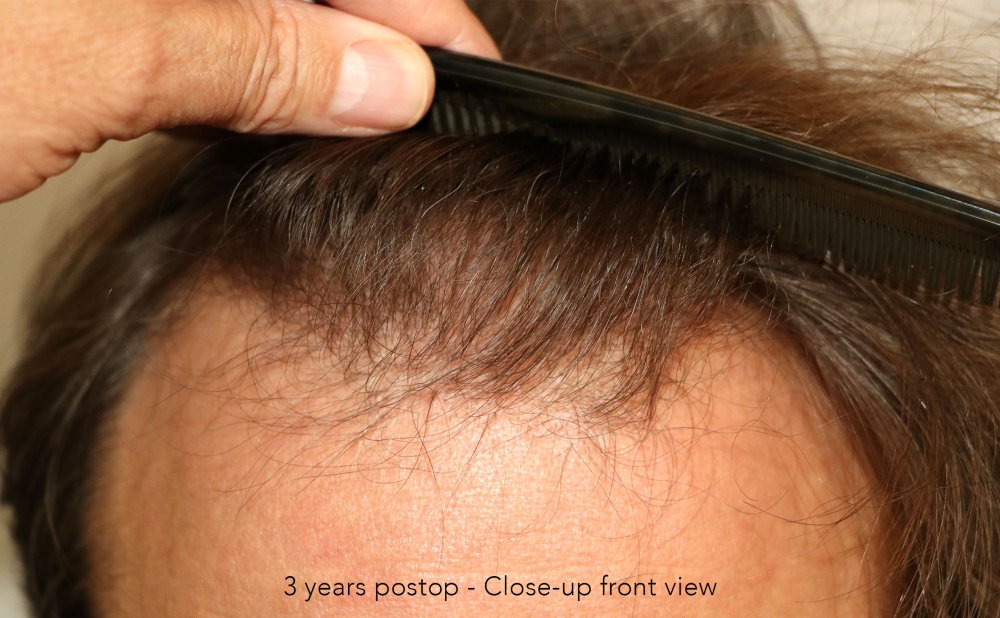 Case performed by Dr. Feriduni – 3378 FU in 1 procedure photo