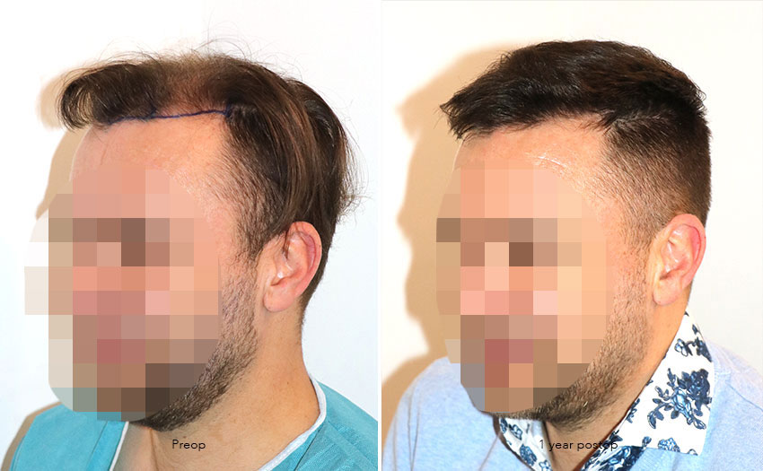 Case performed by Dr. Feriduni – 4008 FU in 1 procedure photo