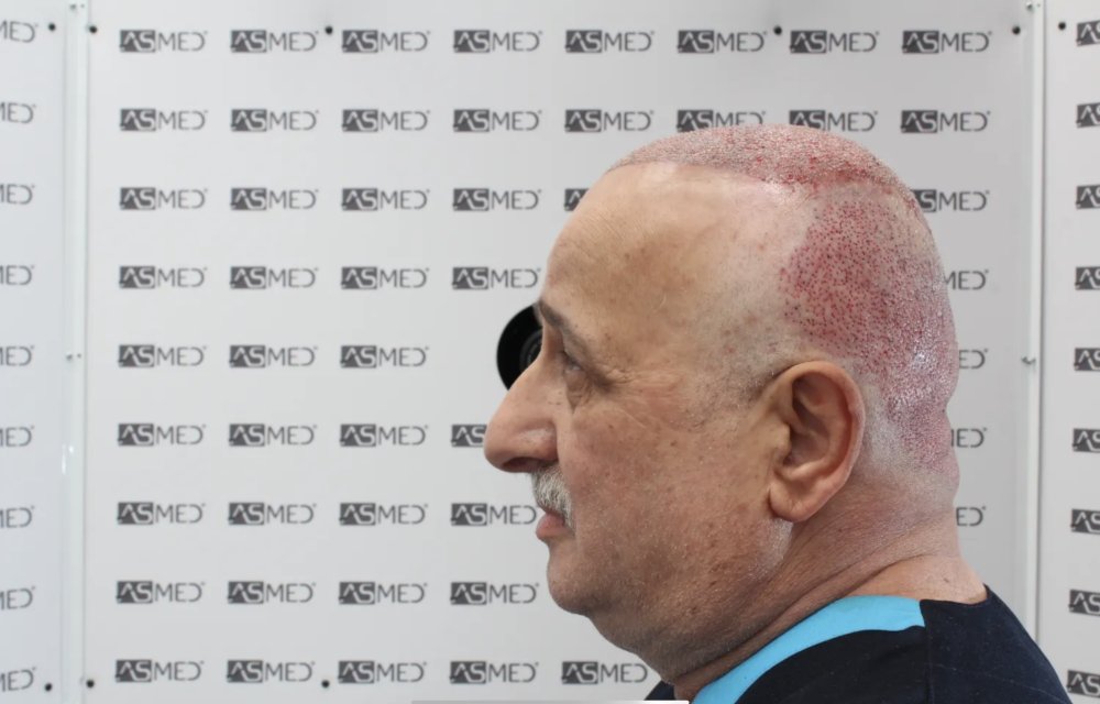 Asmed Clinic - FUE - 4558 Grafts - 12 Month Result. photo