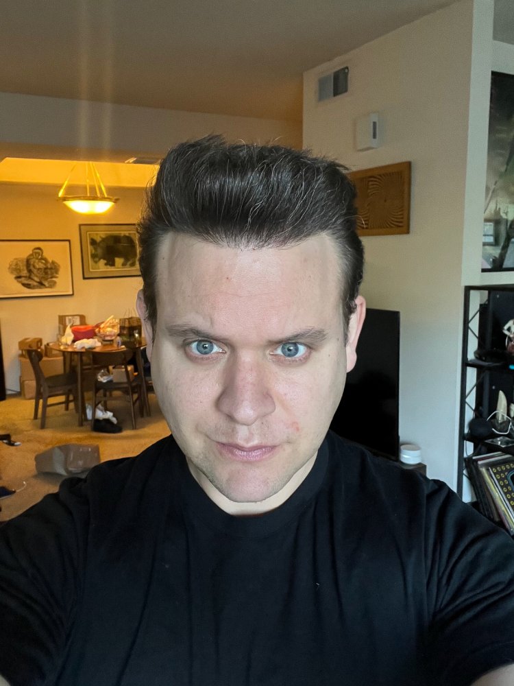 Dr. Ischayek hair restoration result - 1,443 grafts alviarmani photo