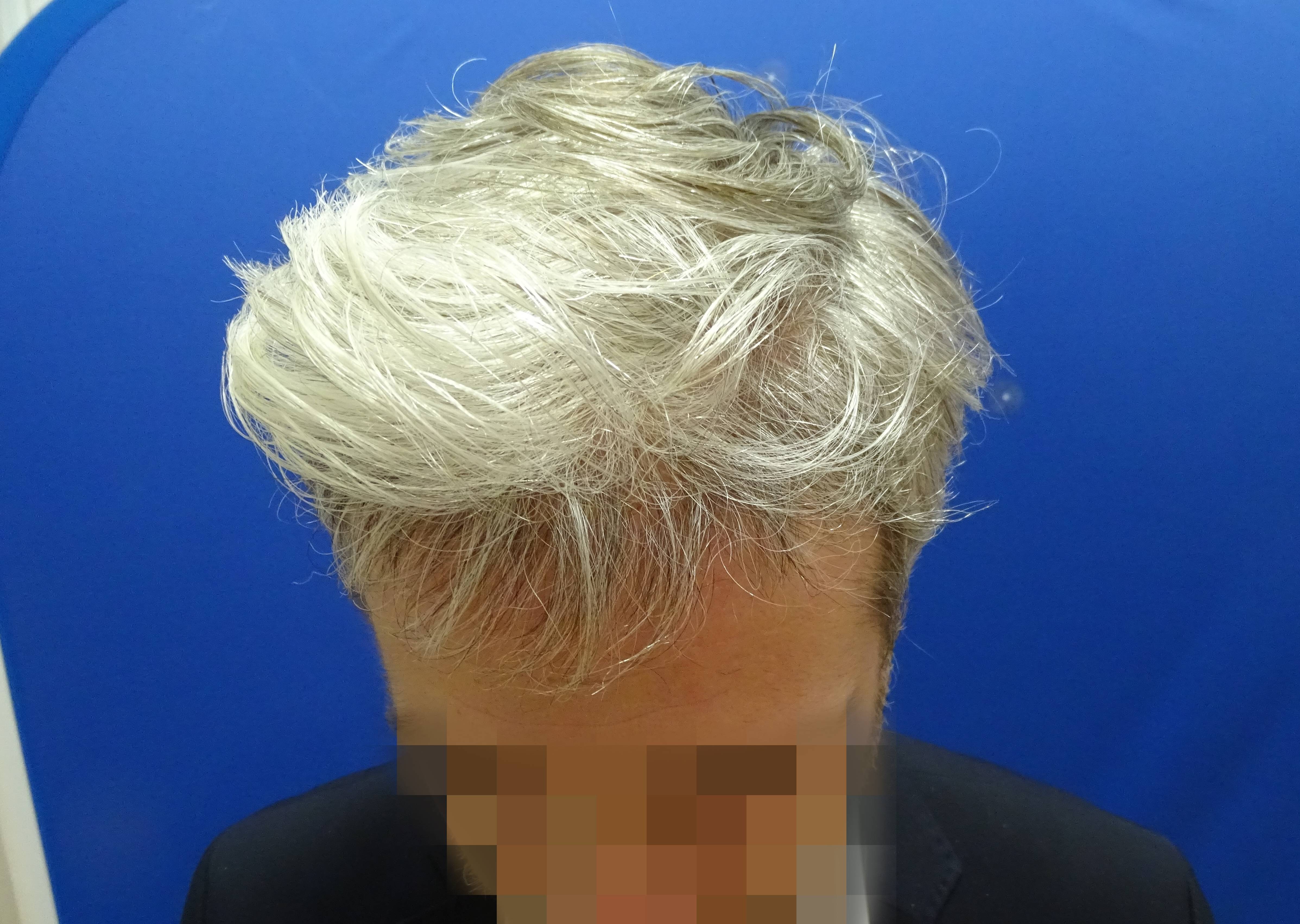 Dr. Bisanga - BHR Clinic - 2180 FUE Repair 0 - 17 Months - Graft Removal and Hairline Reconstruction photo