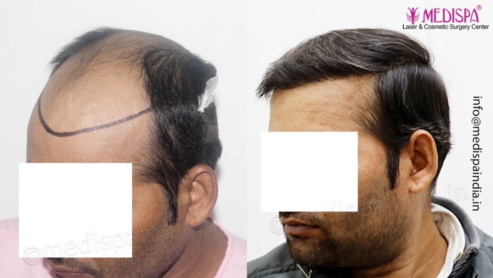 Dr. Suneet Soni - 4992 Grafts | 12-Month Result | Combination FUT + FUE + Beard photo