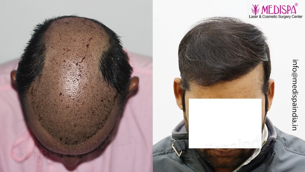 Dr. Suneet Soni - 4992 Grafts | 12-Month Result | Combination FUT + FUE + Beard photo