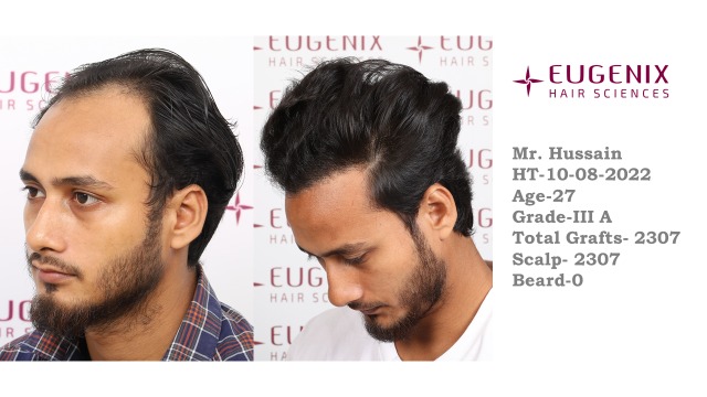 EUGENIX HAIR SCEINCES | GRADE 3A | 9 MONTHS RESULT photo