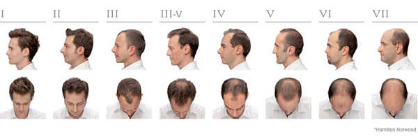 Degree of Hair Loss