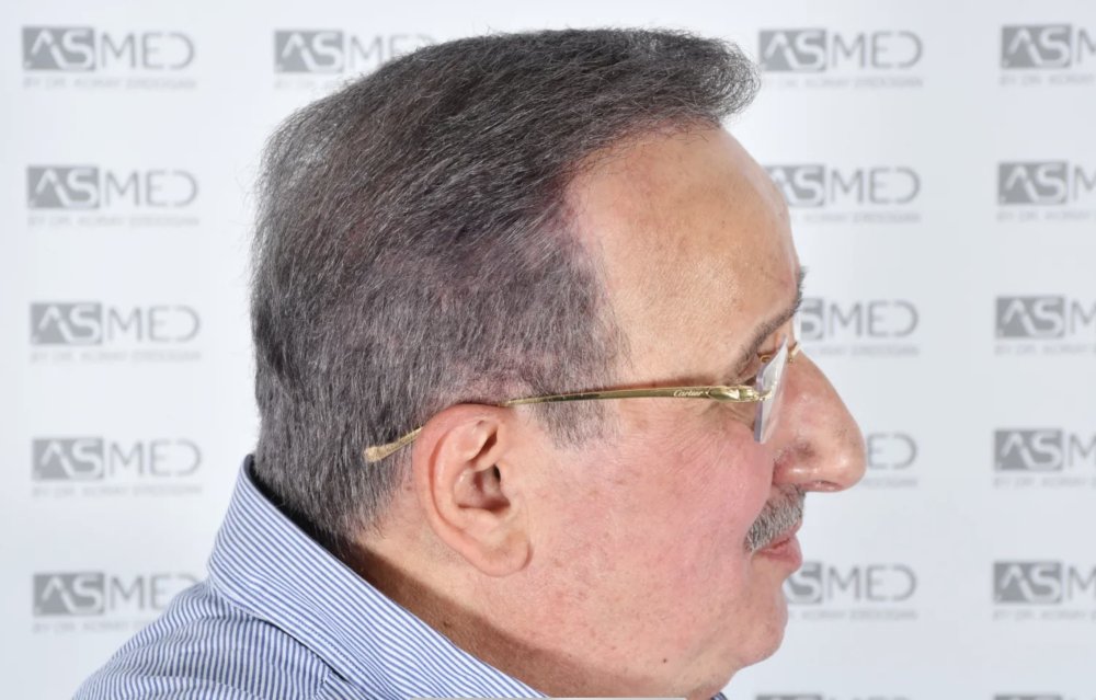 Asmed Clinic - FUE - 4558 Grafts - 12 Month Result. photo