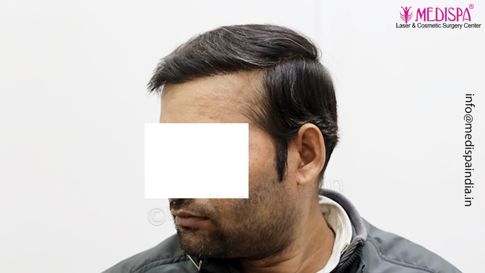 Dr. Suneet Soni - 4992 Grafts | 12-Month Result | Combination FUT + FUE + Beard photo