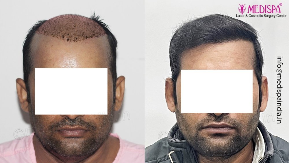 Dr. Suneet Soni - 4992 Grafts | 12-Month Result | Combination FUT + FUE + Beard photo