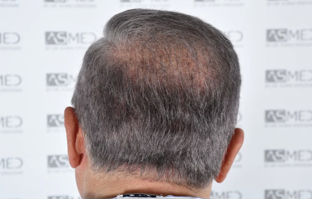 Asmed Clinic - FUE - 4558 Grafts - 12 Month Result. photo