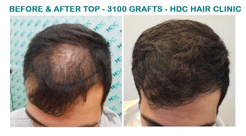 FUE Hair Transplant Result for 3100 Grafts - NW3 – 8 Months After – HDC Hair Clinic photo
