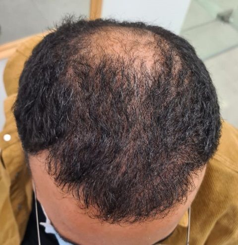Before and after FUE – Top area coverage 3300 grafts – HDC Hair Clinic – Dr Christina photo