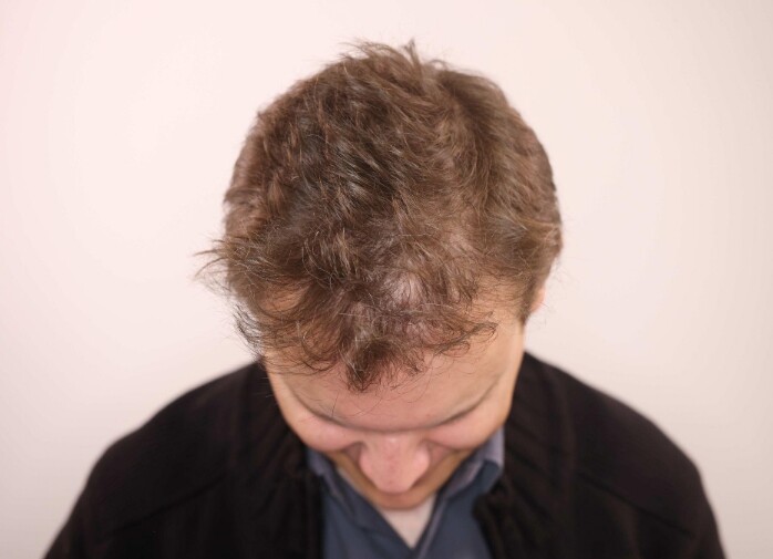 Dr. Ischayek hair restoration result - 1,443 grafts alviarmani photo