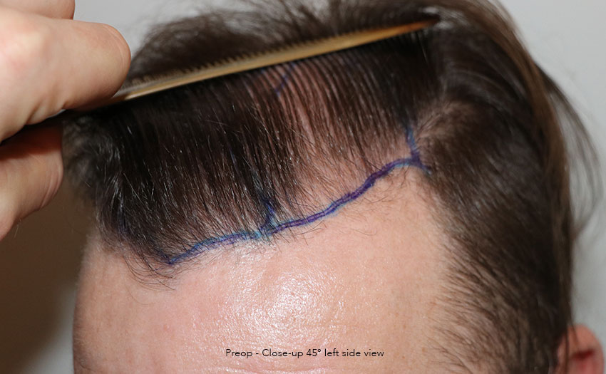 Case performed by Dr. Feriduni – 4008 FU in 1 procedure photo
