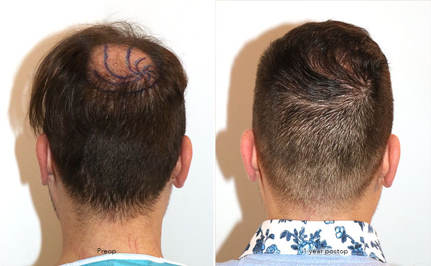 Case performed by Dr. Feriduni – 4008 FU in 1 procedure photo