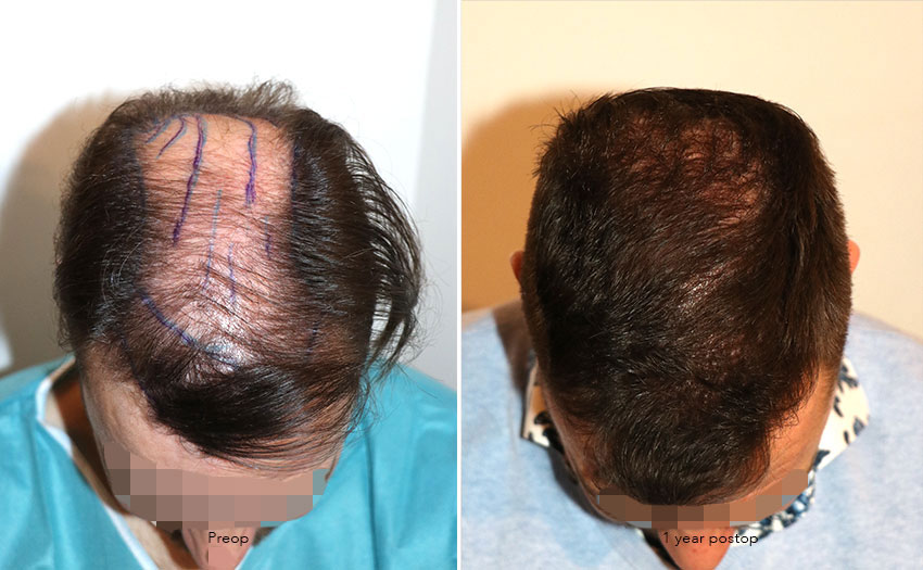 Case performed by Dr. Feriduni – 4008 FU in 1 procedure photo