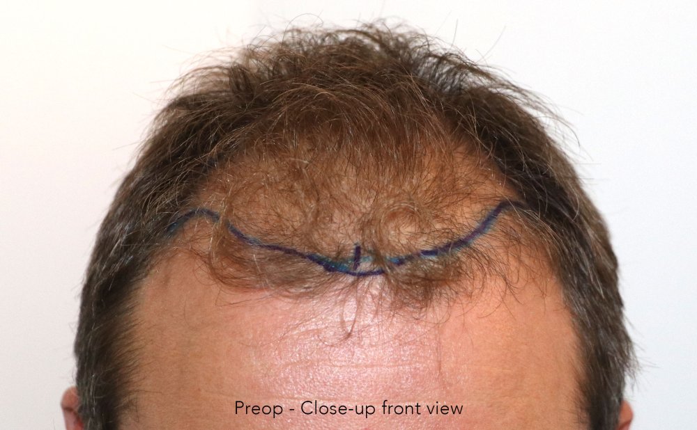 Case performed by Dr. Feriduni – 3378 FU in 1 procedure photo