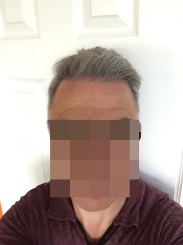 Hair Transplant Results, FUE, 3.000 grafts, Before and After photo