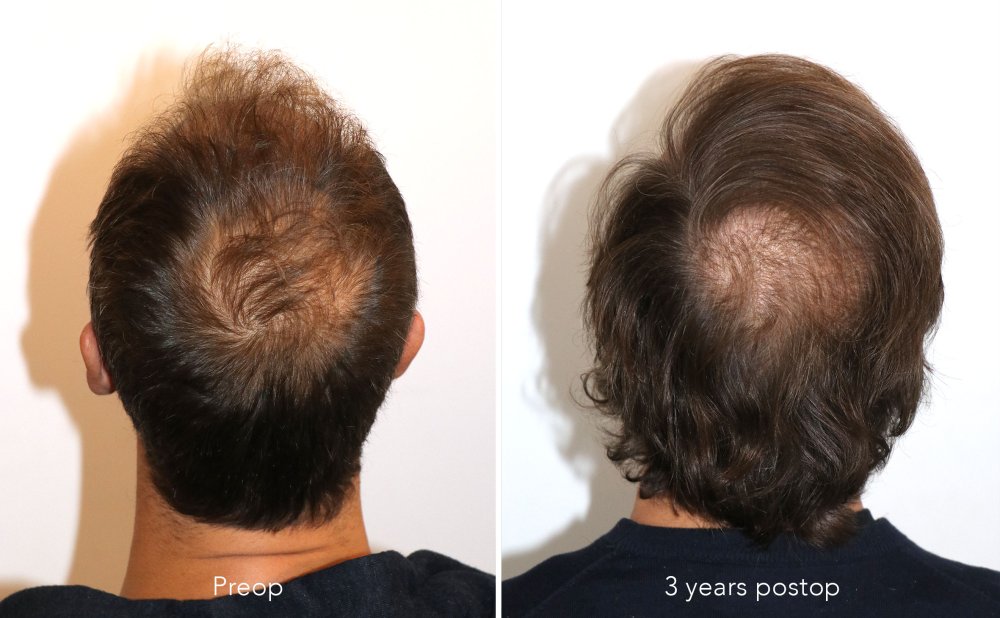 Case performed by Dr. Feriduni – 3378 FU in 1 procedure photo