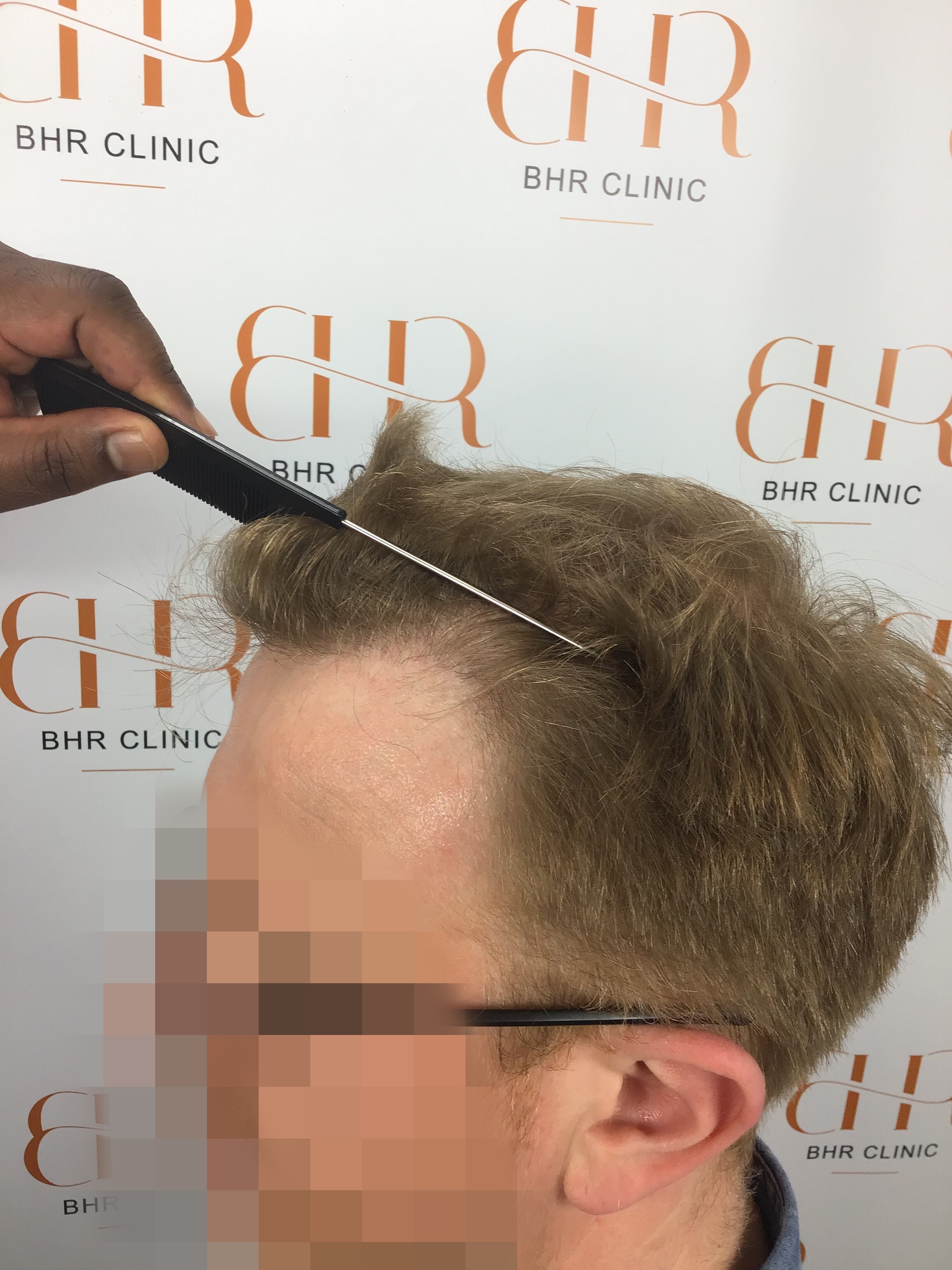 Dr. Bisanga BHR Clinic - 3001 FUE 0 - 15 Months - Fine Blond Hair photo